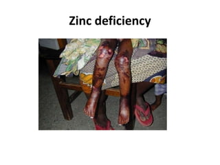 Zinc deficiency
 
