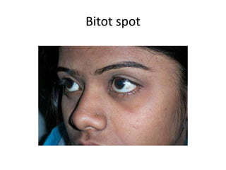 Bitot spot
 
