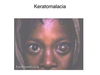 Keratomalacia
 