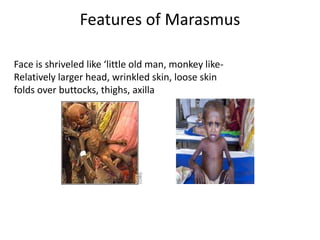 Features of Marasmus
Face is shriveled like ‘little old man, monkey like-
Relatively larger head, wrinkled skin, loose skin
folds over buttocks, thighs, axilla
 