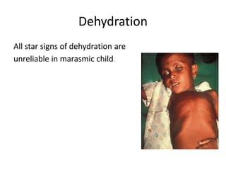 Dehydration
All star signs of dehydration are
unreliable in marasmic child.
 