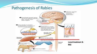 Pathogenesis of Rabies
Local treatment &
RIG
 