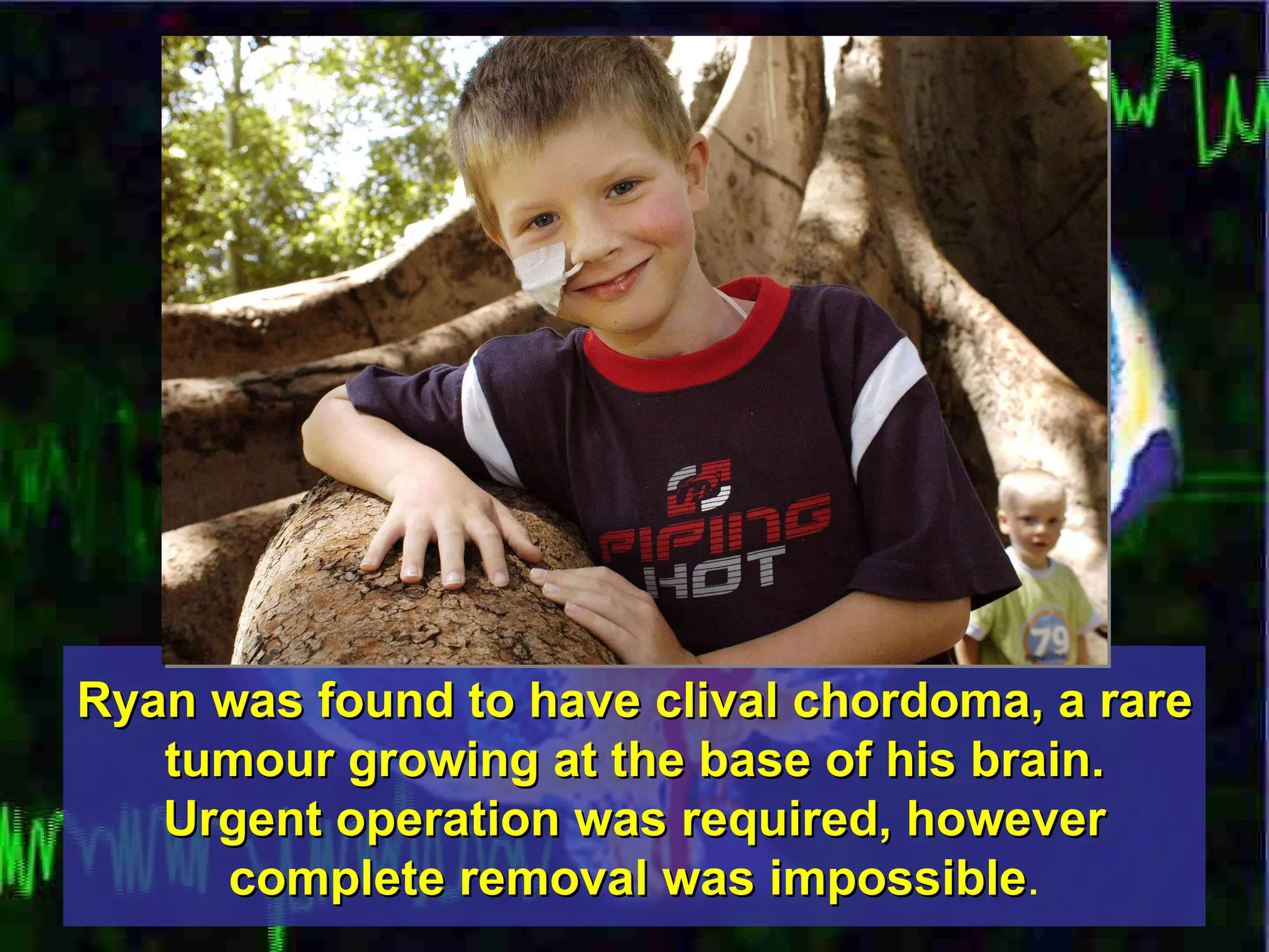 Ryan was found to have clival chordoma, a rare tumour growing at the base of his brain. Urgent operation was required, however complete removal was impossible . 