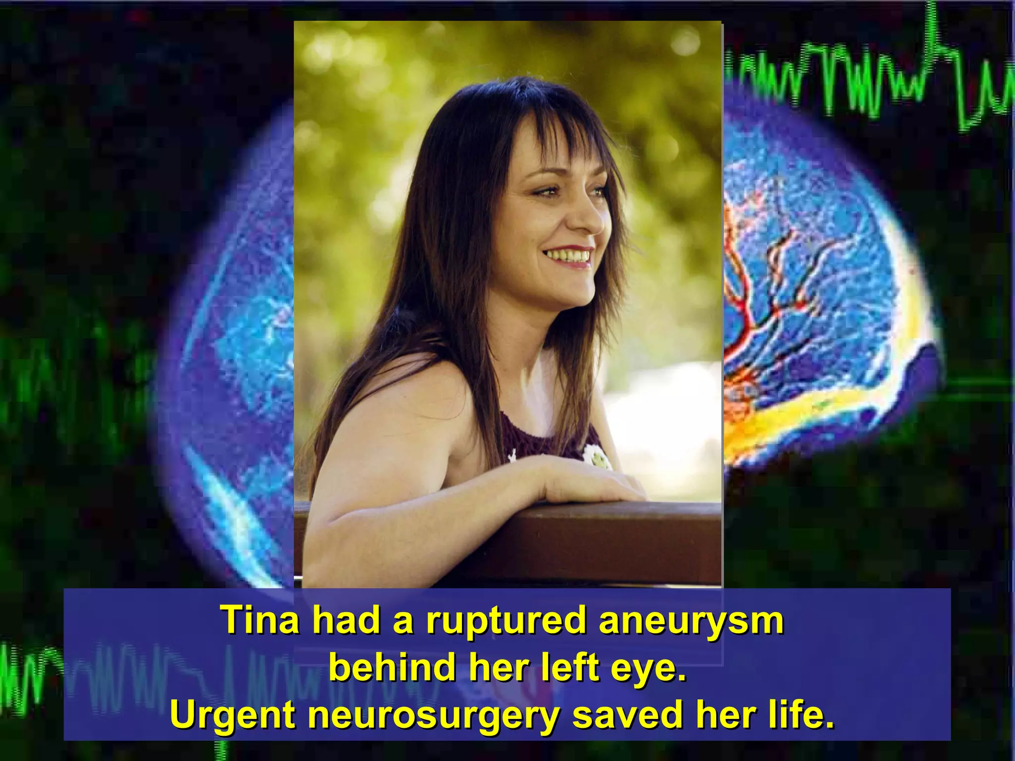 Tina had a ruptured aneurysm  behind her left eye. Urgent neurosurgery saved her life.   