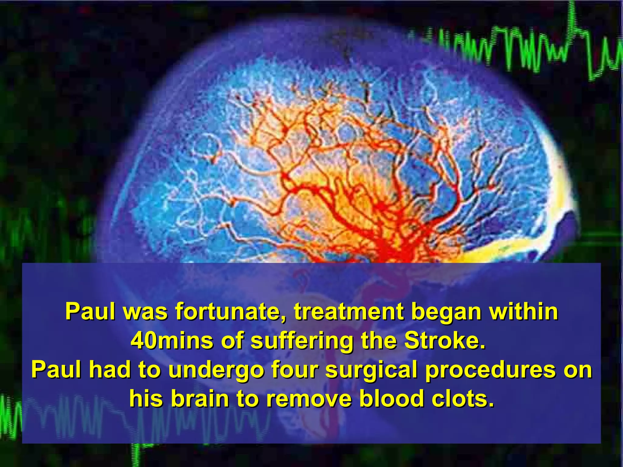 Paul was fortunate, treatment began within 40mins of suffering the Stroke.  Paul had to undergo four surgical procedures on his brain to remove blood clots. 