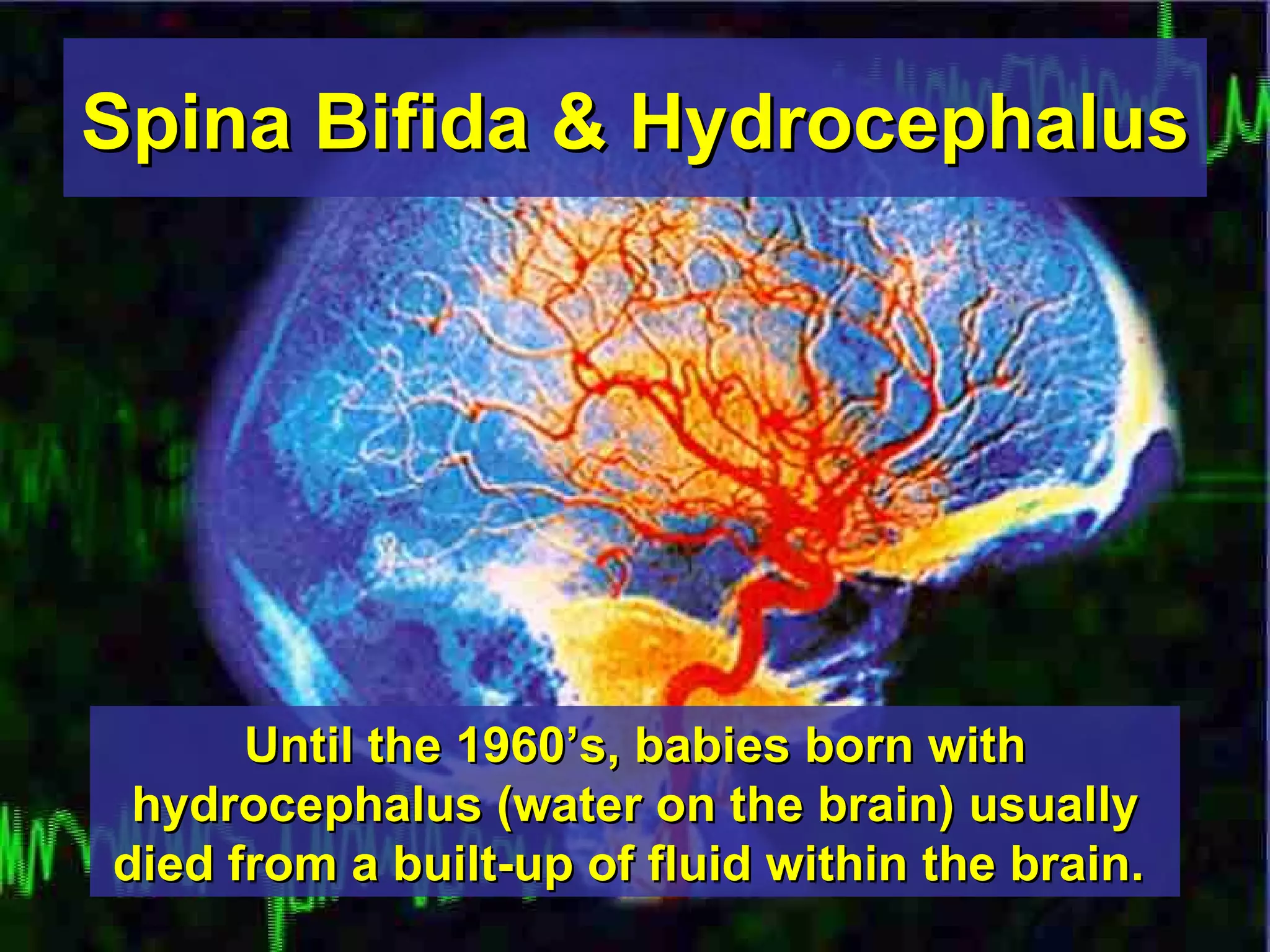 Until the 1960’s, babies born with hydrocephalus (water on the brain) usually died from a built-up of fluid within the brain.   Spina Bifida & Hydrocephalus 