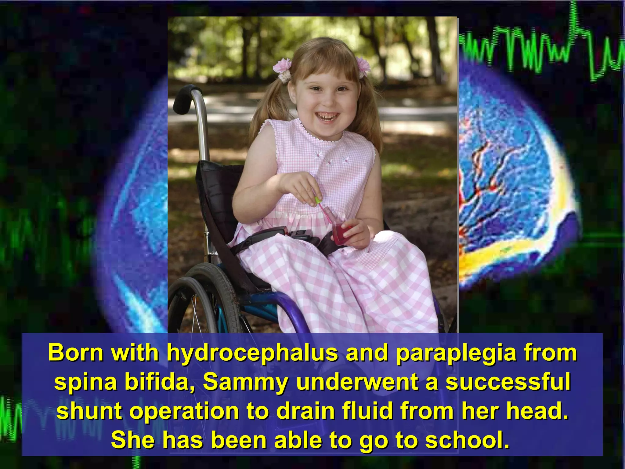 Born with hydrocephalus and paraplegia from spina bifida, Sammy underwent a successful shunt operation to drain fluid from her head. She has been able to go to school.   