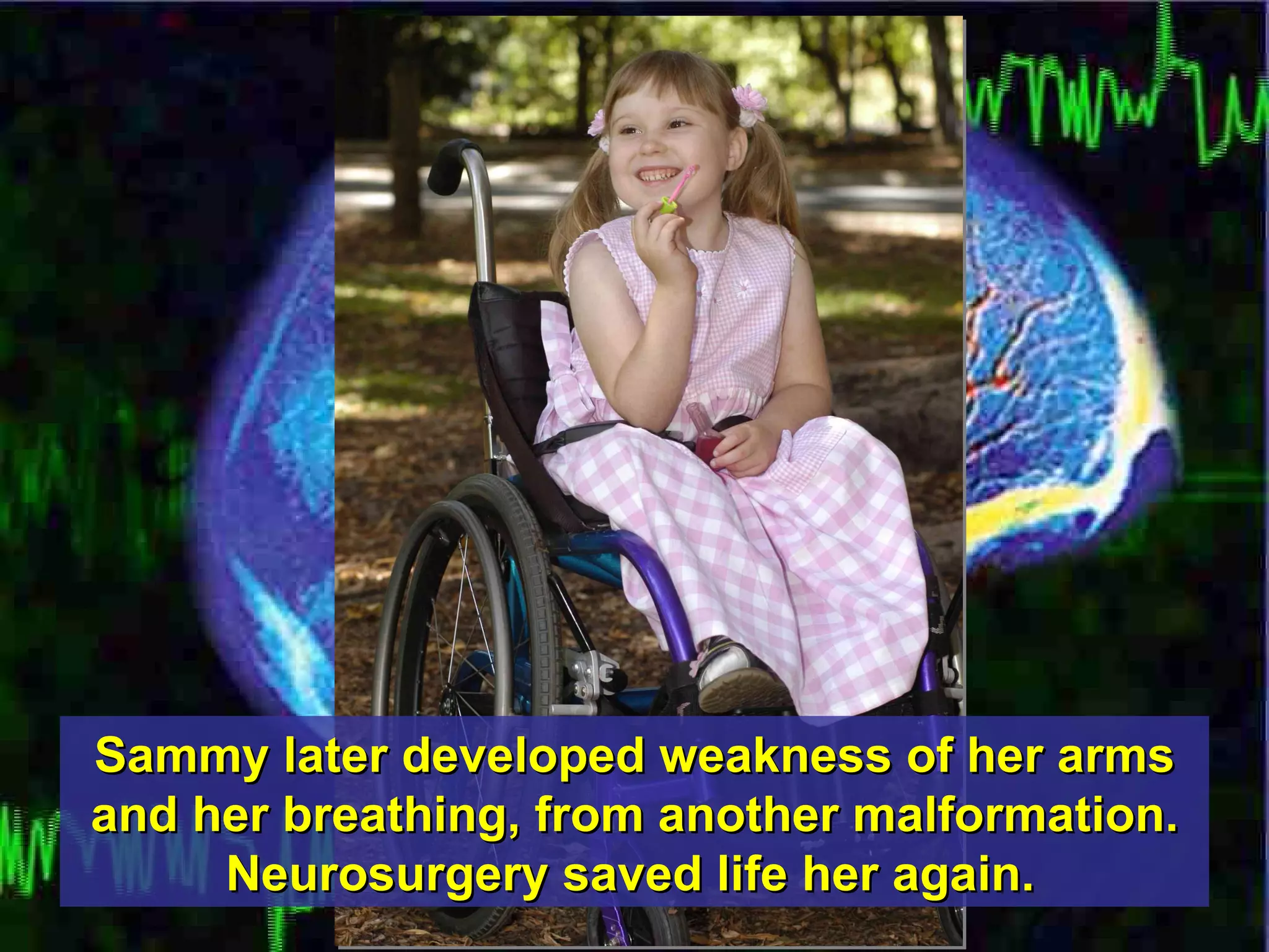 Sammy later developed weakness of her arms and her breathing, from another malformation. Neurosurgery saved life her again.   