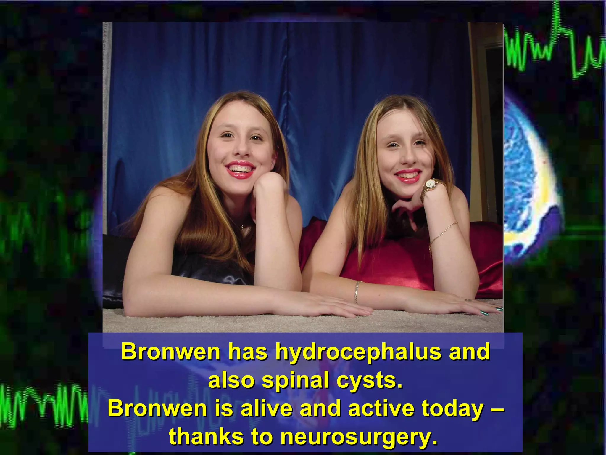 Bronwen has hydrocephalus and also spinal cysts. Bronwen is alive and active today – thanks to neurosurgery.   
