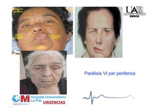 Parálisis VI par periferica
 