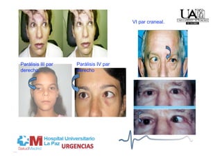 VI par craneal.




Parálisis III par   Parálisis IV par
derecho.            derecho
 