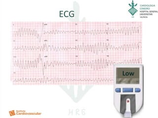 CARDIOLOGIA
ECG
Low
 