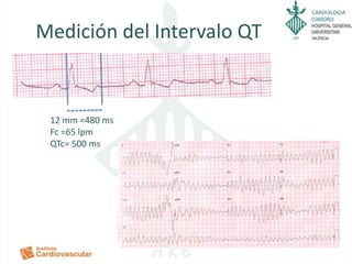 CARDIOLOGIA
Medición del Intervalo QT
12 mm =480 ms
Fc =65 lpm
QTc= 500 ms
 