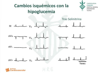 CARDIOLOGIA
Cambios isquémicos con la
hipoglucemia
Tras Solinitrina
 