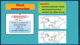 Indication:
 Persistent bradycardia < 60/min
after at least 30 seconds of
ventilation that inflates the lung
Chest
compression
 