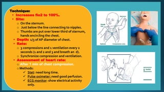 Technique:
 Increases fio2 to 100%.
 Site:
o On the sternum.
o Just below the line connecting to nipples.
o Thumbs are put over lower third of sternum,
hands encircling the chest.
 Depth: 1/3 of AP diameter of chest.
 Rate:
o 3 compressions and 1 ventilation every 2
seconds (1 and 2 and 3 and breath an d).
o Synchronize compression and ventilation.
 Assessment of heart rate:
o After 1 min of chest compression.
o Methods:
 Stet: need long time.
 Pulse oximeter: need good perfusion.
 ECG monitor: show electrical activity
only.
 