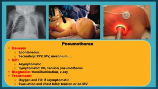 Pneumothorax
 Causes:
o Spontaneous.
o Secondary: PPV, MV, meconium ….
 C/P:
o Asymptomatic
o Symptomatic: RD, Tension pneumothorax.
 Diagnosis: transillumination, x-ray,
 Treatment:
o Oxygen and FU: if asymptomatic
o Evacuation and chest tube: tension or on MV
 