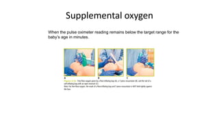 Supplemental oxygen
When the pulse oximeter reading remains below the target range for the
baby’s age in minutes.
 