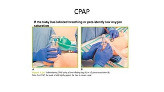 CPAP
If the baby has labored breathing or persistently low oxygen
saturation
 