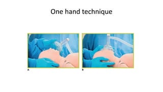 One hand technique
 