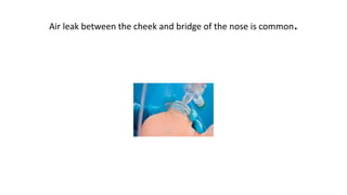 Air leak between the cheek and bridge of the nose is common.
 