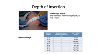 Depth of insertion
Nasotragal length :
The estimated insertion depth (cm) is
NTL +1 cm.
Gestational age
 