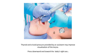 Thyroid and cricoid pressure provided by an assistant may improve
visualization of the larynx.
Press downward and toward the baby’s right ear.
 