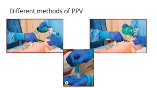 Different methods of PPV
 