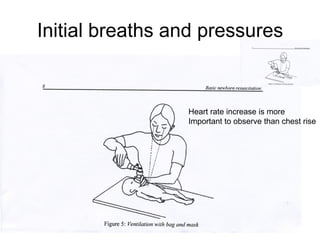 Initial breaths and pressures
• Initiation of intermittent positive-
pressure ventilation at birth can
be accomplished with either shorter or
longer inspiratory times.
• Initial peak inflating pressures needed are
variable- start with 20 cm H2O may be
effective but 30-40 Cm H2O may be
needed.
• PEEP is likely to be beneficial
Heart rate increase is more
Important to observe than chest rise
 
