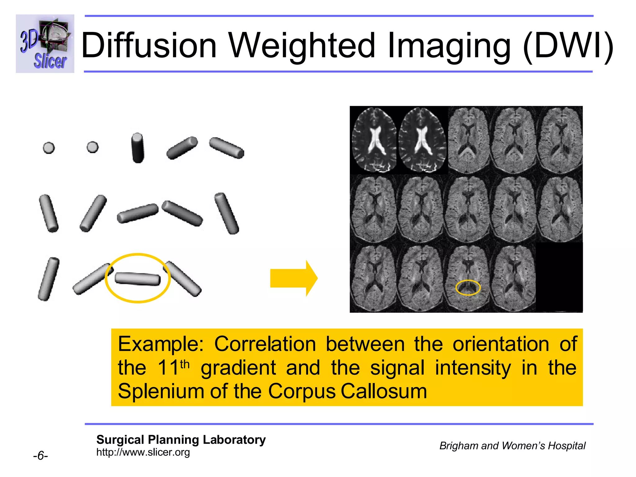 Diffusion Weighted Imaging (DWI) Example: Correlation between the orientation of the 11 th  gradient and the signal intensity in the Splenium of the Corpus Callosum 
