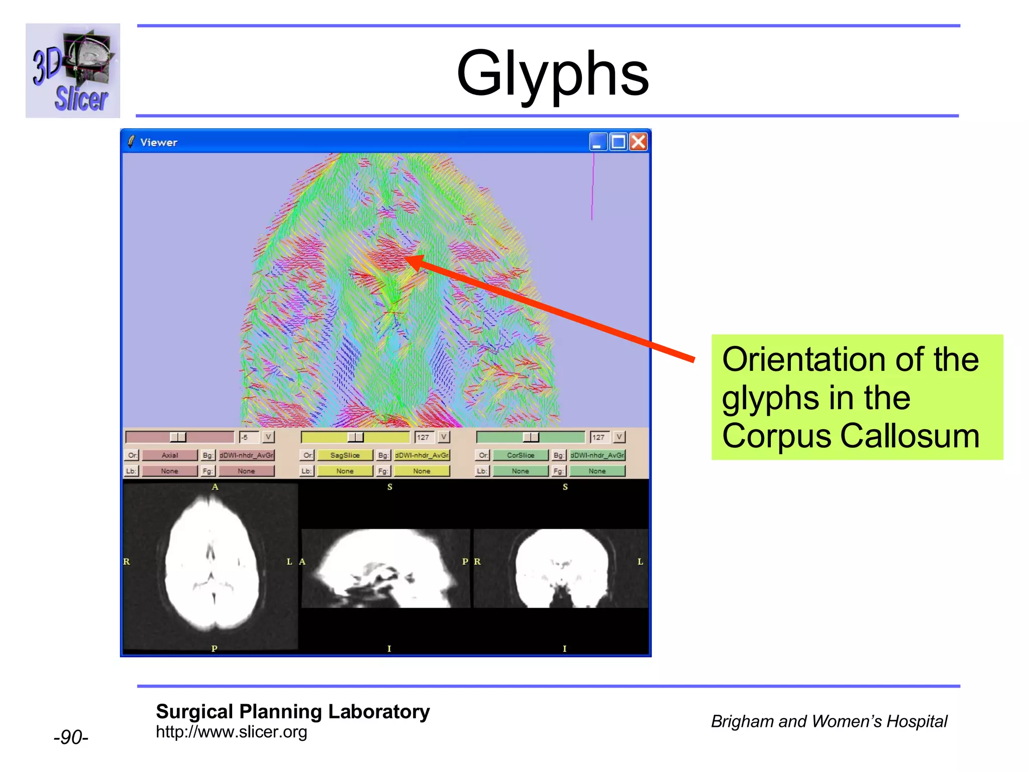 Glyphs Orientation of the glyphs in the Corpus Callosum 
