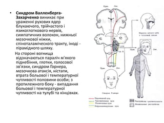 • Синдром Валленберга-
Захарченко виникає при
ураженні рухових ядер
блукаючого, трійчастого і
язикоглоткового нервів,
симпатичних волокон, нижньої
мозочкової ніжки,
спіноталаміческого тракту, іноді -
пірамідного шляху.
На стороні вогнища
відзначаються параліч м'якого
піднебіння, глотки, голосової
зв'язки, синдром Горнера,
мозочкова атаксія, ністагм,
втрата больової і температурної
чутливості половини особи; з
протилежного боку - випадання
больової і температурної
чутливості на тулубі та кінцівках.
 
