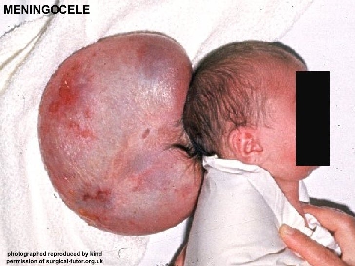 photo of 25 week old fetus