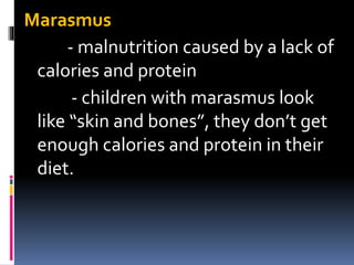 Marasmus
- malnutrition caused by a lack of
calories and protein
- children with marasmus look
like “skin and bones”, they don’t get
enough calories and protein in their
diet.
 
