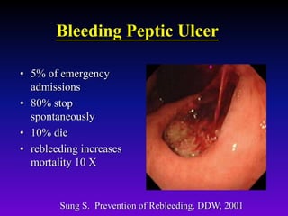 Bleeding Peptic Ulcer
• 5% of emergency
admissions
• 80% stop
spontaneously
• 10% die
• rebleeding increases
mortality 10 X
Sung S. Prevention of Rebleeding. DDW, 2001
 