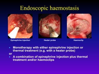 Endoscopic haemostasis
 Monotherapy with either epinephrine injection or
thermal treatment (e.g. with a heater probe)
or
 A combination of epinephrine injection plus thermal
treatment and/or haemoclips
Epinephrine injection HaemoclipHeater probe
 