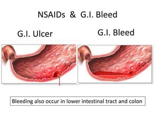NSAIDs & G.I. Bleed
G.I. Ulcer

G.I. Bleed

Bleeding also occur in lower intestinal tract and colon

 
