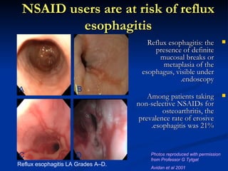 NSAID users are at risk of reflux
         esophagitis
                                        Reflux esophagitis: the              
                                          presence of definite
                                            mucosal breaks or
                                             metaplasia of the
                                      esophagus, visible under
                                                   .endoscopy
A                     B
                                        Among patients taking                
                                    non-selective NSAIDs for
                                             osteoarthritis, the
                                     prevalence rate of erosive
                                         .esophagitis was 21%


C                    D                   Photos reproduced with permission
                                         from Professor G Tytgat
Reflux esophagitis LA Grades A–D.
                                         Avidan et al 2001
 