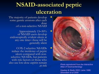 NSAID-associated peptic
           ulceration
The majority of patients develop      
 some gastric erosions after each
                             dose
     .of a non-selective NSAID
        Approximately 15–30%          
       of NSAID users develop
 endoscopically evident ulcers at
    any one time– these will be
                 .generally silent
       COX-2 selective NSAIDs         
   reduce the incidence of peptic
      ulcers compared with non-
  selective NSAIDs, but patients
   with risk factors or those who
also use low-dose aspirin remain          Photo reproduced from the Interactive
                           .at risk       Atlas of Gastroenterology
                                          Hawkey & Skelly 2002; Laine 1996;
                                          Silverstein et al 2000
 