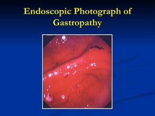 Endoscopic Photograph of
      Gastropathy
 