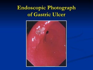 Endoscopic Photograph
   of Gastric Ulcer
 