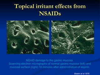 Topical irritant effects from
              NSAIDs




             NSAID damage to the gastric mucosa.
Scanning electron micrographs of normal gastric mucosa (left) and
 mucosal surface (right) 16 minutes after administration of aspirin.

                                                      Baskin et al 1976
 