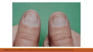 Chapter: Nephrotic syndrome Author(s): Premil Rajakrishna, Stewart Cameron, and Neil Turner From: Oxford Textbook of Clinical Nephrology
 