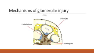 Mechanisms of glomerular injury
 