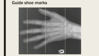 Guide shoe marks
 