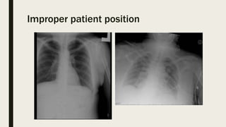 Improper patient position
 