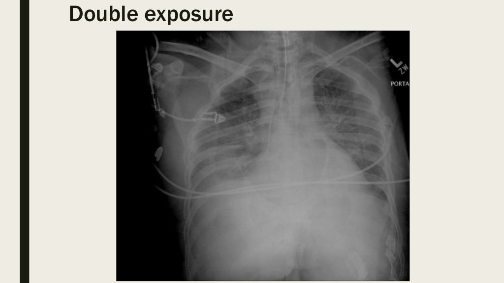 Radiographic screen film artifacts