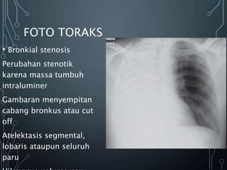FOTO TORAKS
• Bronkial stenosis
Perubahan stenotik
karena massa tumbuh
intraluminer
Gambaran menyempitan
cabang bronkus atau cut
off
Atelektasis segmental,
lobaris ataupun seluruh
paru
 