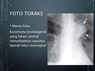 FOTO TORAKS
• Massa hilus
Karsinoma bronkogenik
yang lokasi sentral
menyebabkan opasitas
daerah hilus meningkat
 