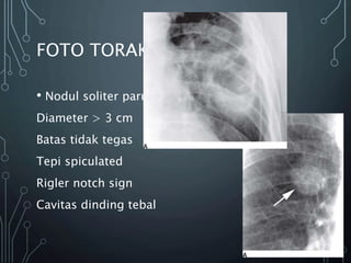 FOTO TORAKS
• Nodul soliter paru
Diameter > 3 cm
Batas tidak tegas
Tepi spiculated
Rigler notch sign
Cavitas dinding tebal
 